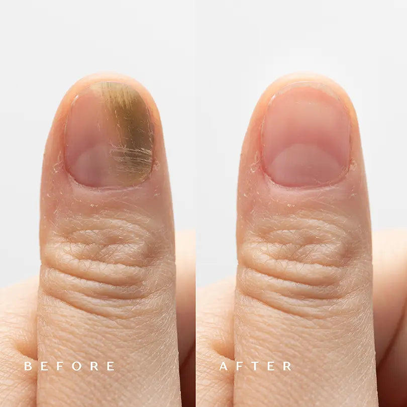 Epurist™ Nail Renewal Antifungal Pen
